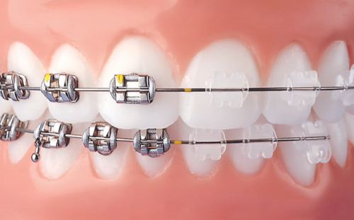 How Braces Can Effectively Align Teeth for Liverpool Residents